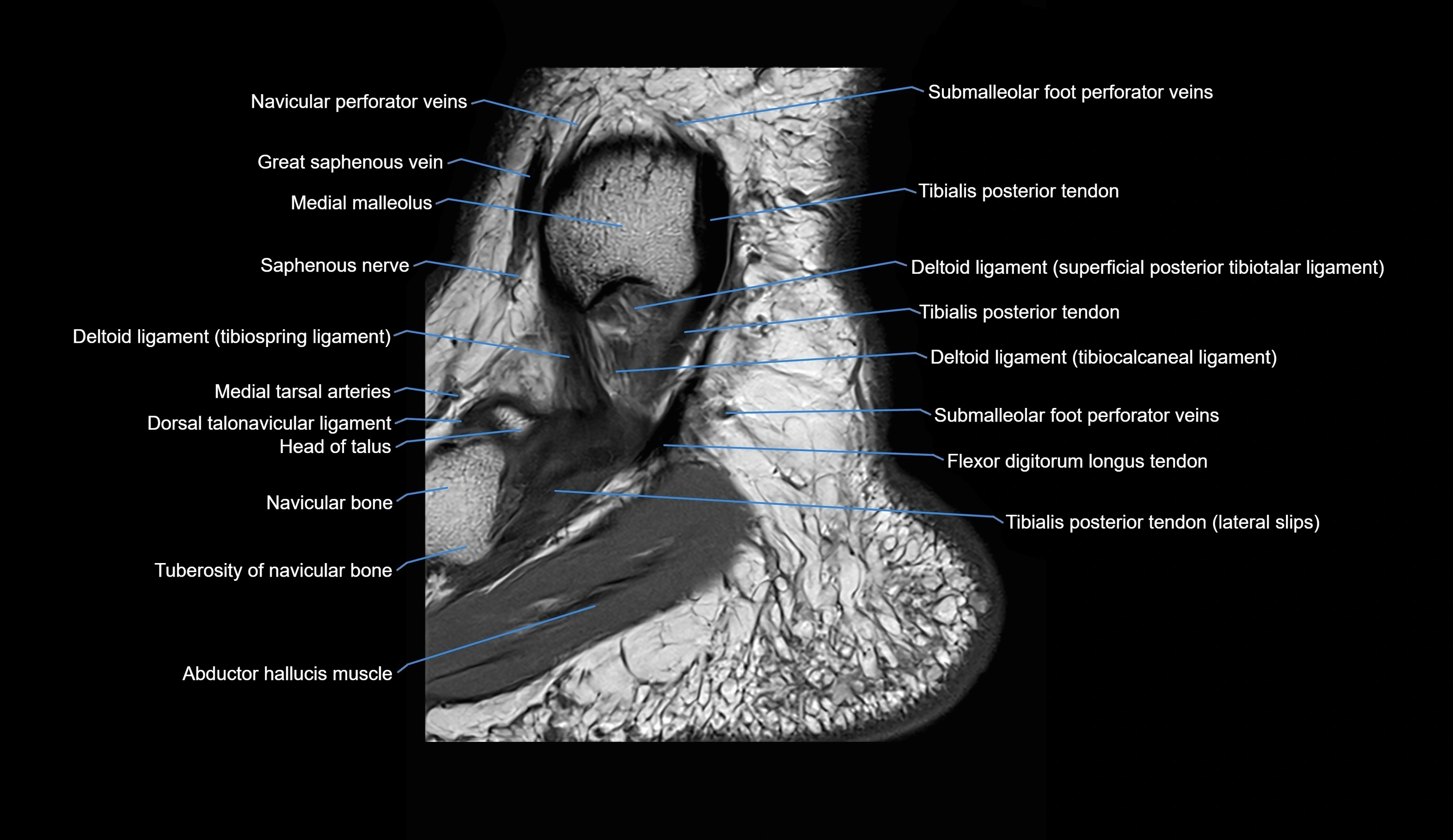 MRI Ankle sagittal cross sectional anatomy 3T  radiology  image-img-00001-00006.webp